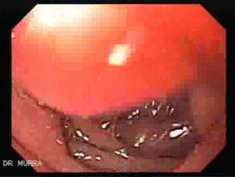 Duodenal Ulcer (2 of 5)