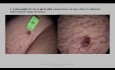 Vulva Tumor Vestibulo Urethral Excision and Flap