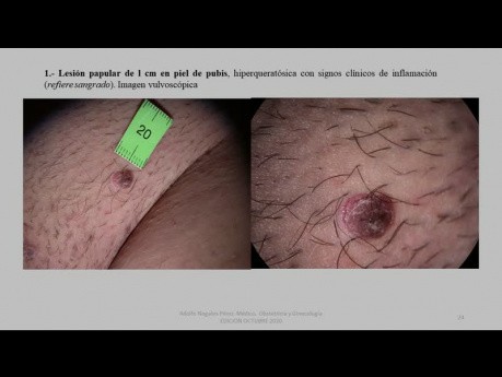 Vulva Tumor Vestibulo Urethral Excision and Flap