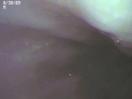 Endoscopic Look at Distal Esophagitis