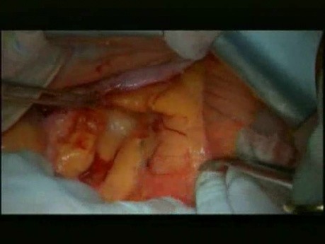 Open Right Hemicolectomy – Technical Principles - Operation No 1 - Part 1