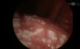 Cordectomy Coblation