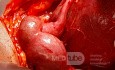 Endometriosic Hydrosalpinx