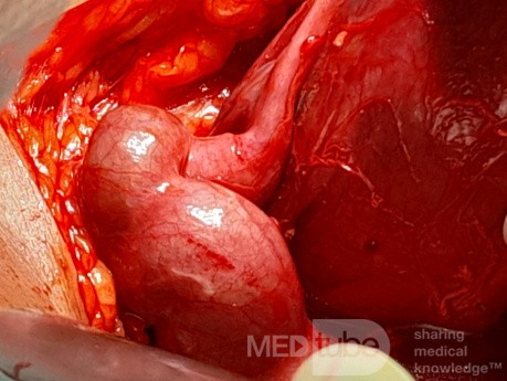 Endometriosic Hydrosalpinx