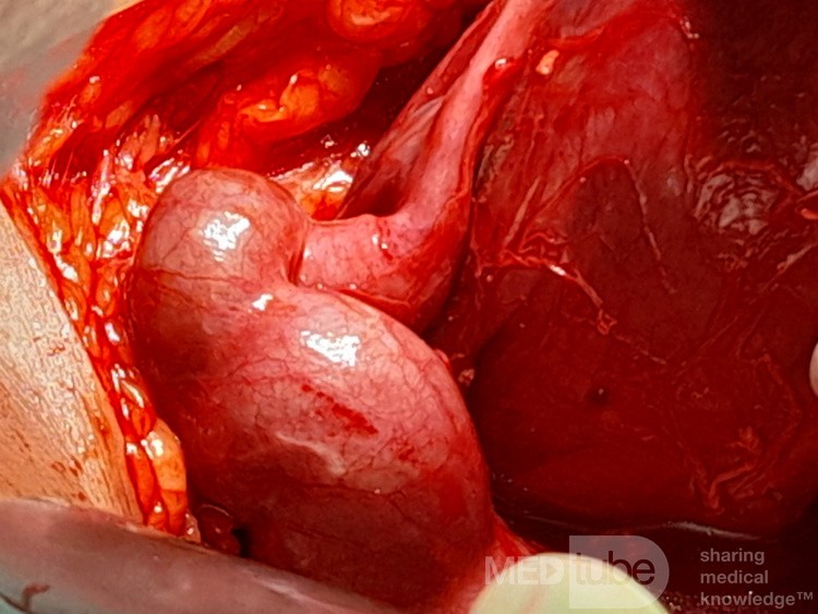 Endometriosic Hydrosalpinx