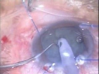 Floppy Iris Syndrome
