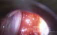 Cervical adenocarcinoma (carcinoma glandulare colli uteri)