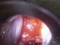 Cervical adenocarcinoma (carcinoma glandulare colli uteri)