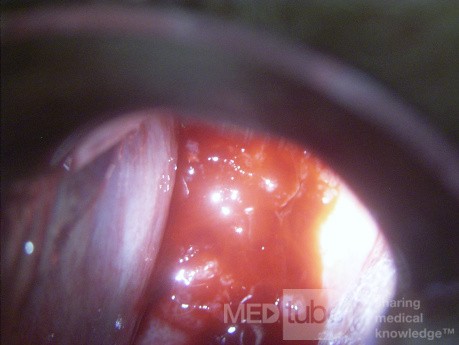 Cervical adenocarcinoma (carcinoma glandulare colli uteri)