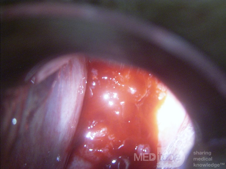 Cervical adenocarcinoma (carcinoma glandulare colli uteri)