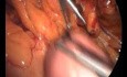 Laparoscopic Conversion of VBG to CRnYGB Including Technical Problems and Complication Management