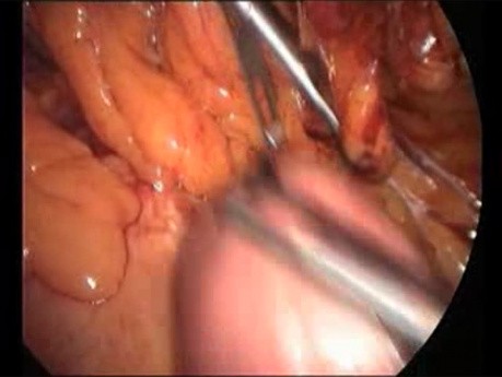 Laparoscopic Conversion of VBG to CRnYGB Including Technical Problems and Complication Management
