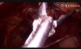 Laparoscopic Repair of Bilateral Inguinal Hernia