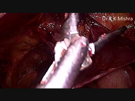 Laparoscopic Repair of Bilateral Inguinal Hernia