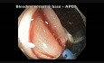 Transcolon - Large Sessile Polyp - EMR And Clip Closure