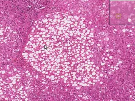 Alcoholic liver disease - Histopathology - Liver