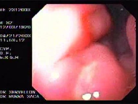 Acute Bleeding - Ulcer of the Gastric Body