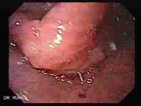 Candidiasis - Lesions in the Oropharynx