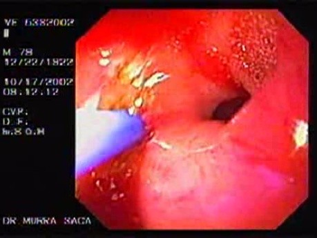 Duodenal Ulcer and Bleeding (4 of 4)