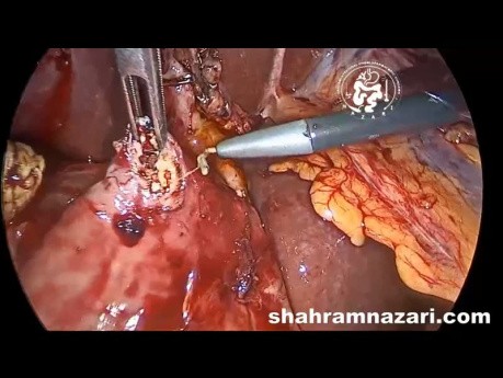 Laparoscopic Method of CBD Exploration and Stone Clearance via Washout Technique in Gastric Bypass