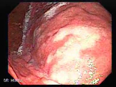 Systemic Lupus Erythematosus - Stomach finding (1 of 7)
