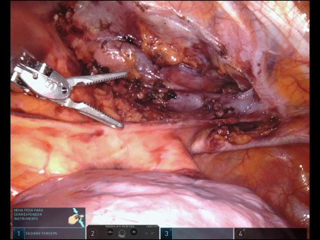 Mediastinal Tumor - Ectopic Thyroid