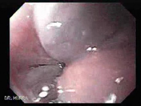Alcoholic Cirrhosis - Presence of Scars After Eradication of Esophageal Varices, Part 2