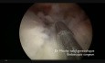 Hysteroscopic Endometrial Polypectomy with Cold Scissors