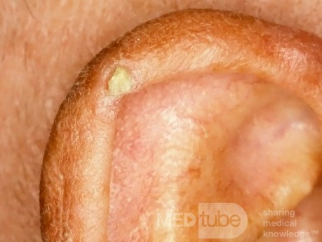 Solar Keratosis [Actinic Keratosis or Senile Keratosis]
