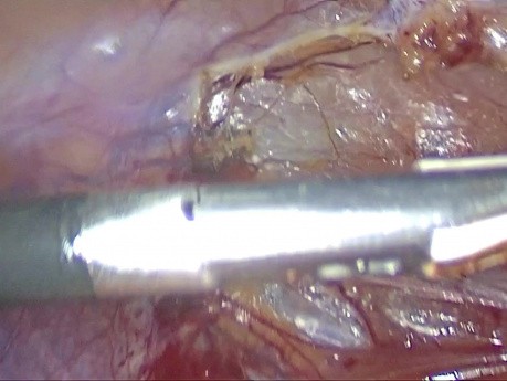 Ileocecal Resection by Laparoscopy for Crohn’s Disease