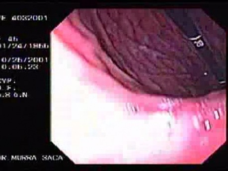 Gastric Folds