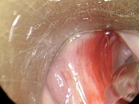 Endoscopic Removal of Vocal Cord Polyp