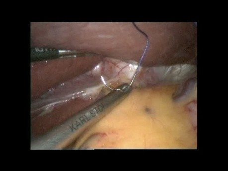 Laparoscopic Total Gastrectomy D2 LND