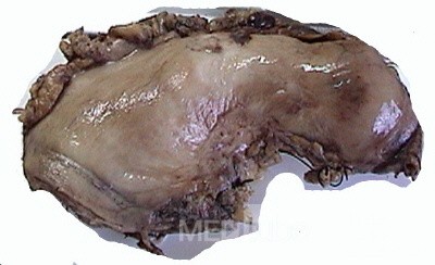Plastic Linitis with bilateral Krukenberg´s tumor (9 of 13)