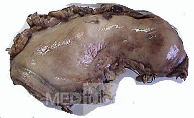Plastic Linitis with bilateral Krukenberg´s tumor (9 of 13)
