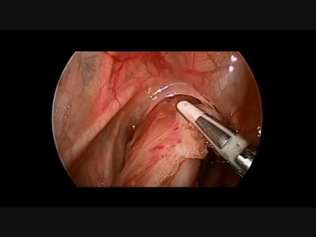 Laparoscopic Swenson Pull-through Procedure for Hirschsprung Disease