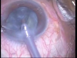 Phacoemulsification - Stop And Chop Technique