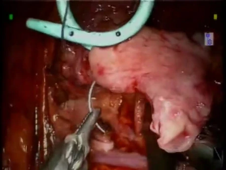 Ureteropelvic Junction Stenosis-A Personalized Approach