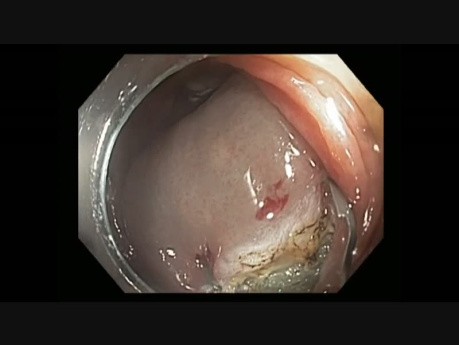 Colonoscopy - Ascending Colon En Bloc EMR