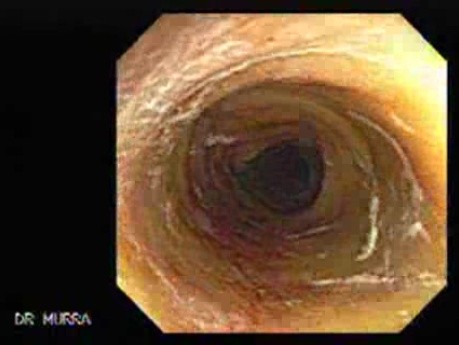 Yellowish Colonic Mucosa (2 of 2)