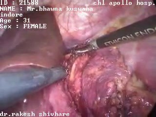 Laparoscopic left adrenalectomy