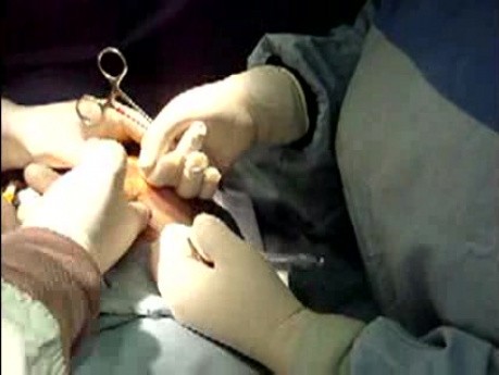 Breast augmentation surgery