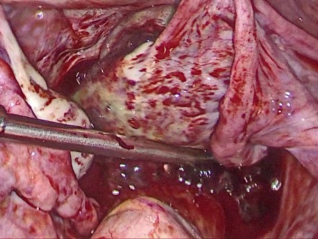 Ovarian Ectopic Pregnancy