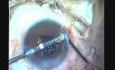 Phacoemulsification And IOL Implantation