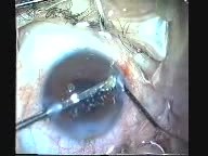 Phacoemulsification And IOL Implantation