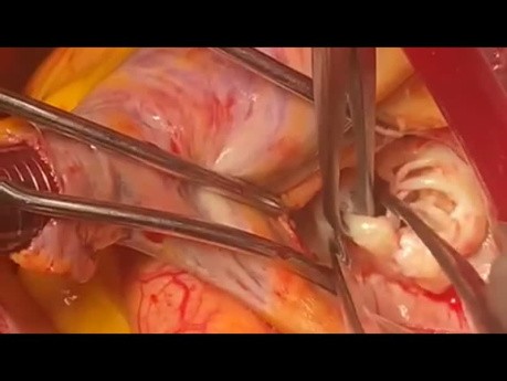 Patient with Dual Papillary Muscle Avulsion