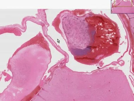 Brain - Arteriovenous malformation