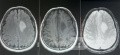 Surgical Planning with Neuronavigator in Patient with Intracranial Mass Lesion. High Grade Glioma.