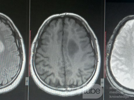 Surgical Planning with Neuronavigator in Patient with Intracranial Mass Lesion. High Grade Glioma.
