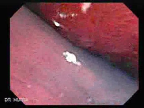 Colonoscopic Polypectomy (5 of 23)